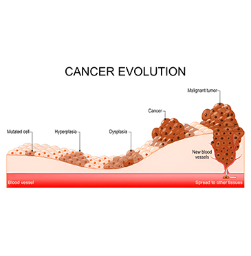 Cancer Stages Explained: A Guide To Diagnosis And Treatment